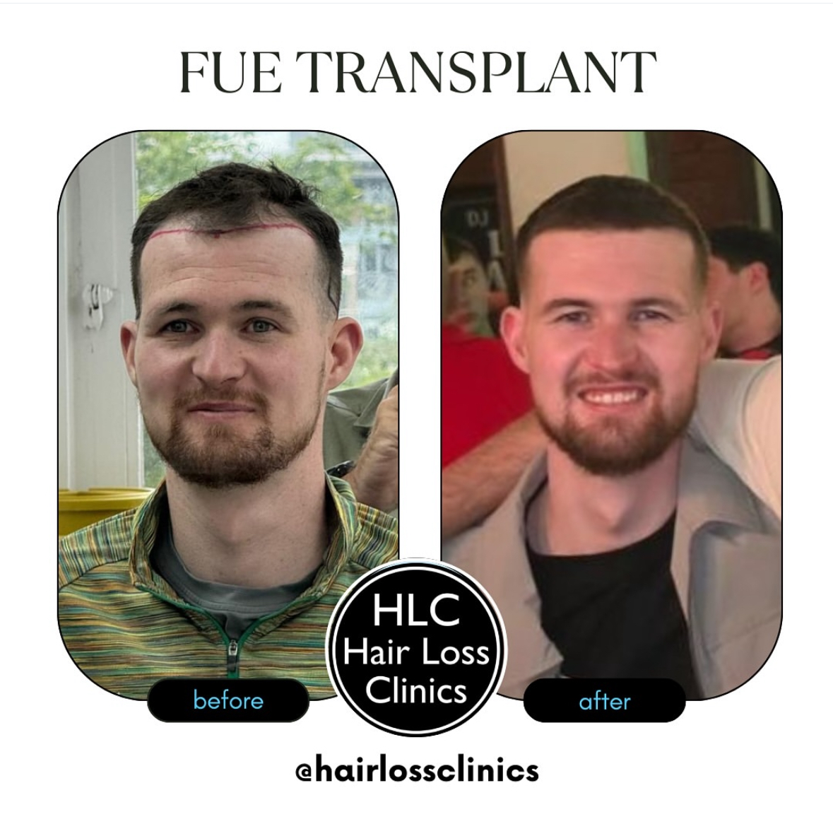 Hair Transplantation