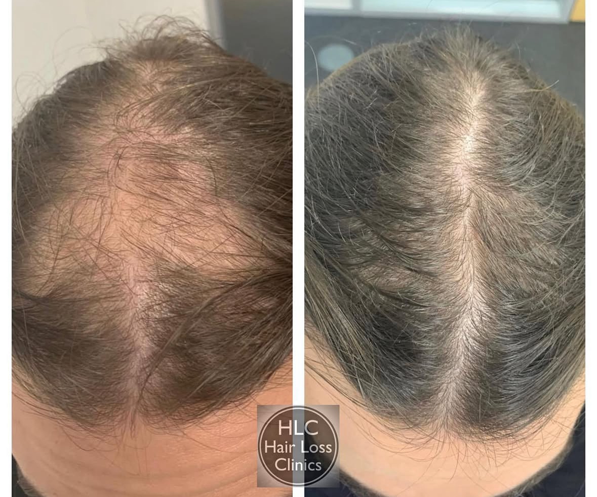 Therapeutic lasers work by stimulating blood flow to the hair bulb and scalp, enhancing the delivery of oxygen and essential nutrients through increased red blood cell activity. When combined with a targeted regime—including scalp lotions, hair vitamins, and medicated scalp shampoos this cutting-edge technology stands out as one of the most effective hair regrowth treatments available today.