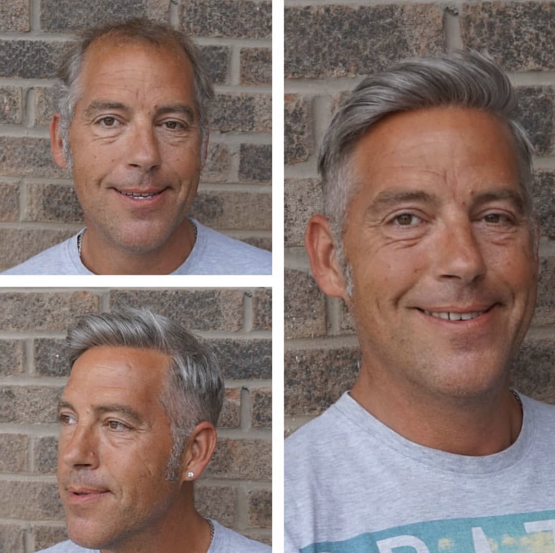 Non-Surgical Hair Replacement